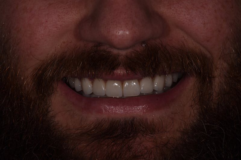 Patient Smile Before & After Gallery - Patient 495410 - Image 4