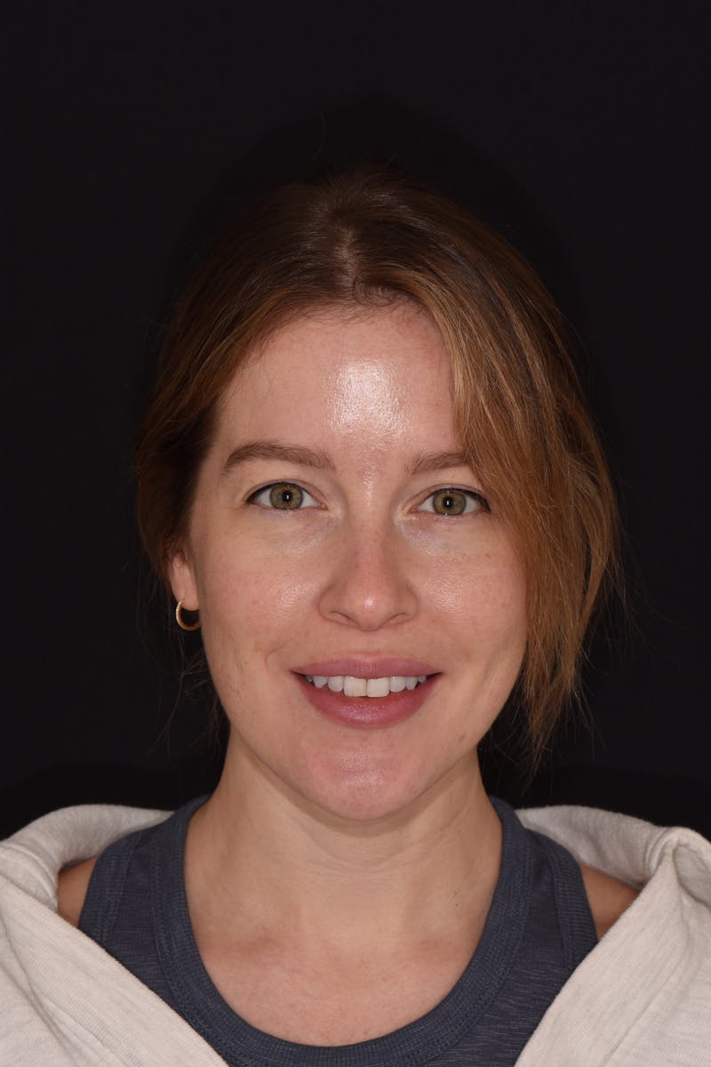 Patient Smile Before & After Gallery - Patient 172841 - Image 1