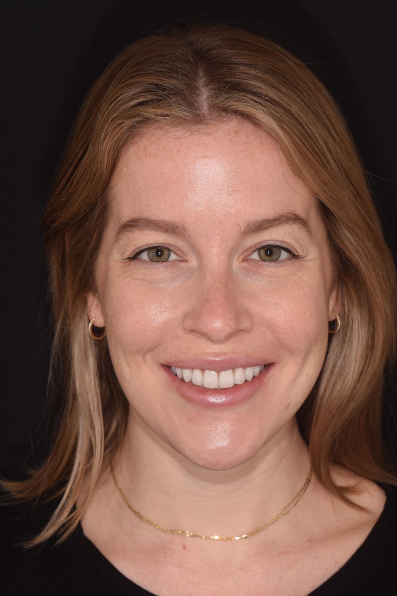 Patient Smile Before & After Gallery - Patient 172841 - Image 2