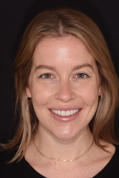 Patient Smile Before & After Gallery - Patient 172841 - Image 2