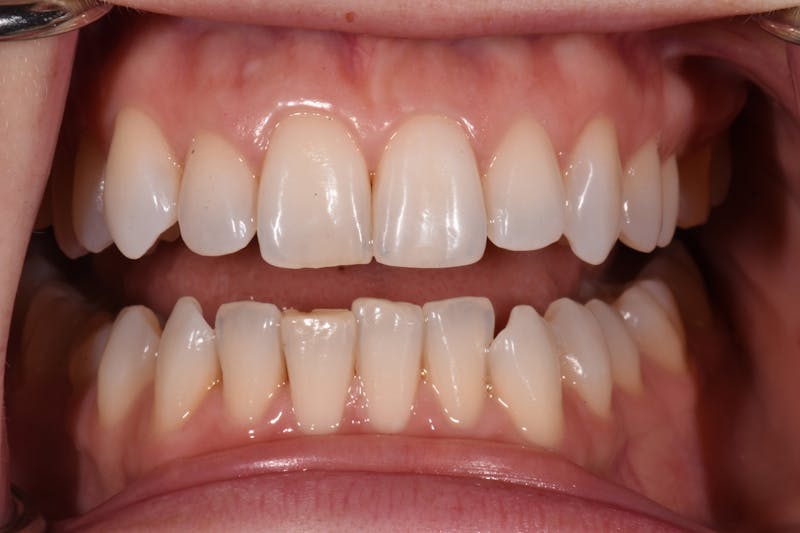 Patient Smile Before & After Gallery - Patient 172841 - Image 3