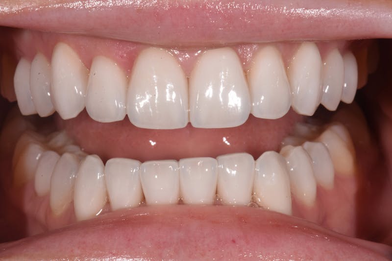 Patient Smile Before & After Gallery - Patient 172841 - Image 4