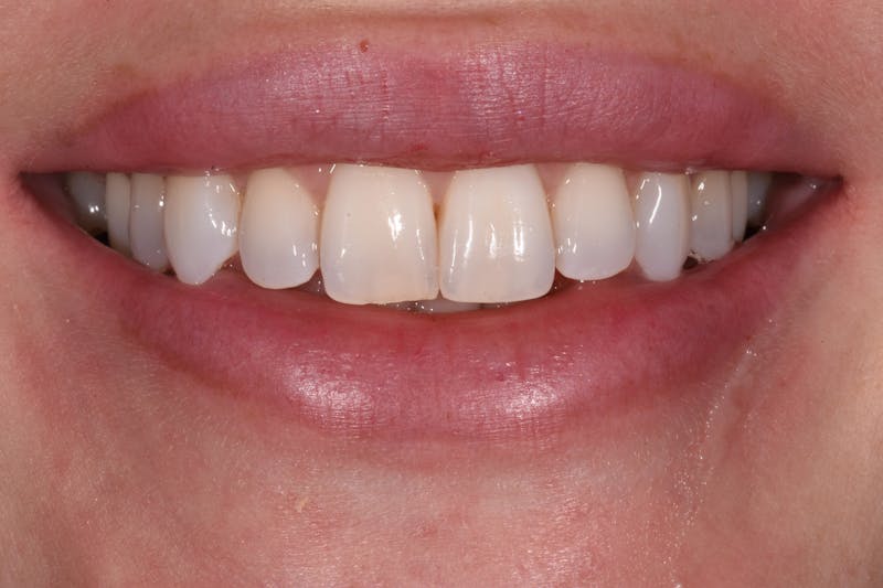 Patient Smile Before & After Gallery - Patient 172841 - Image 5