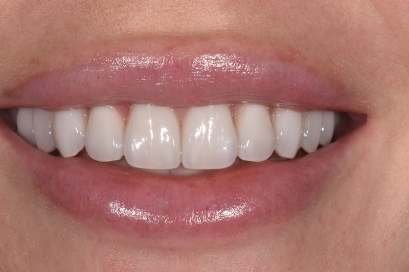 Patient Smile Before & After Gallery - Patient 172841 - Image 6