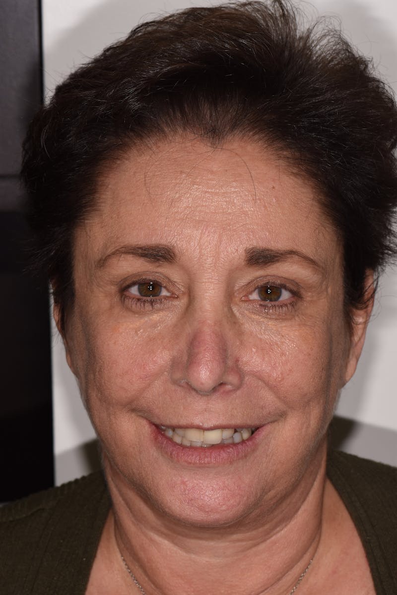 Patient Smile Before & After Gallery - Patient 632751 - Image 1