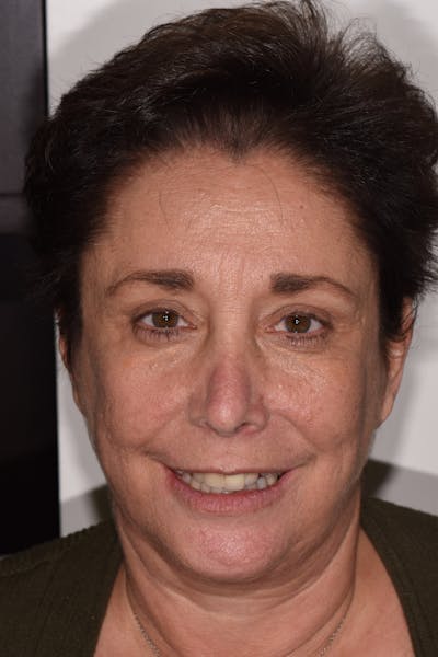 Patient Smile Before & After Gallery - Patient 632751 - Image 1