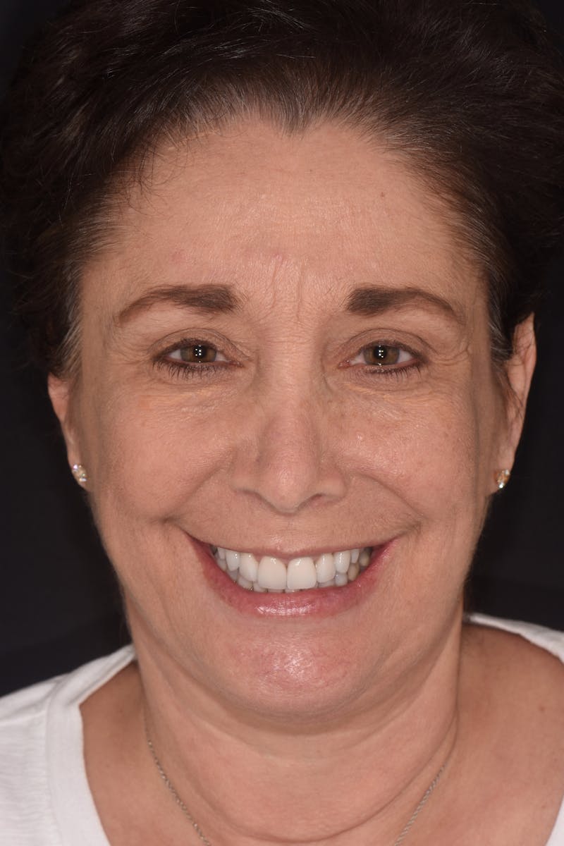 Patient Smile Before & After Gallery - Patient 632751 - Image 2
