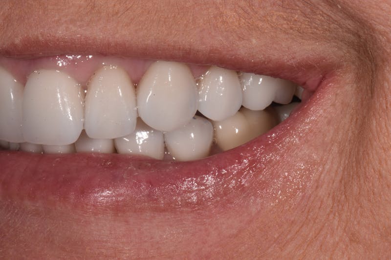 Patient Smile Before & After Gallery - Patient 632751 - Image 4