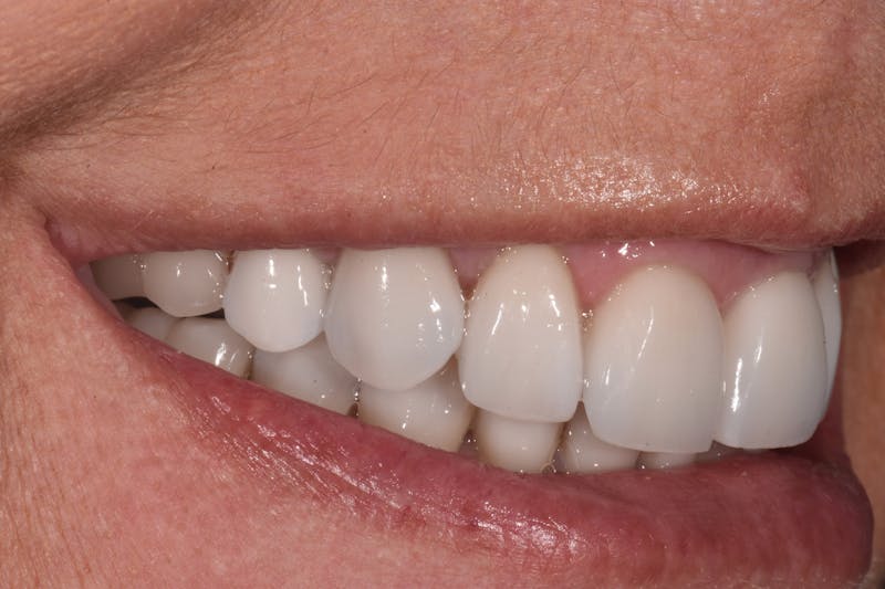 Patient Smile Before & After Gallery - Patient 632751 - Image 6