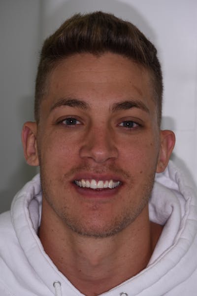 Patient Smile Before & After Gallery - Patient 319776 - Image 1