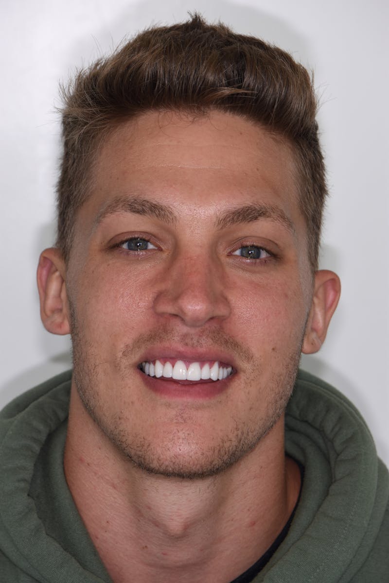 Patient Smile Before & After Gallery - Patient 319776 - Image 2