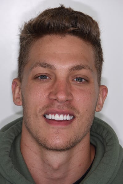 Patient Smile Before & After Gallery - Patient 319776 - Image 2