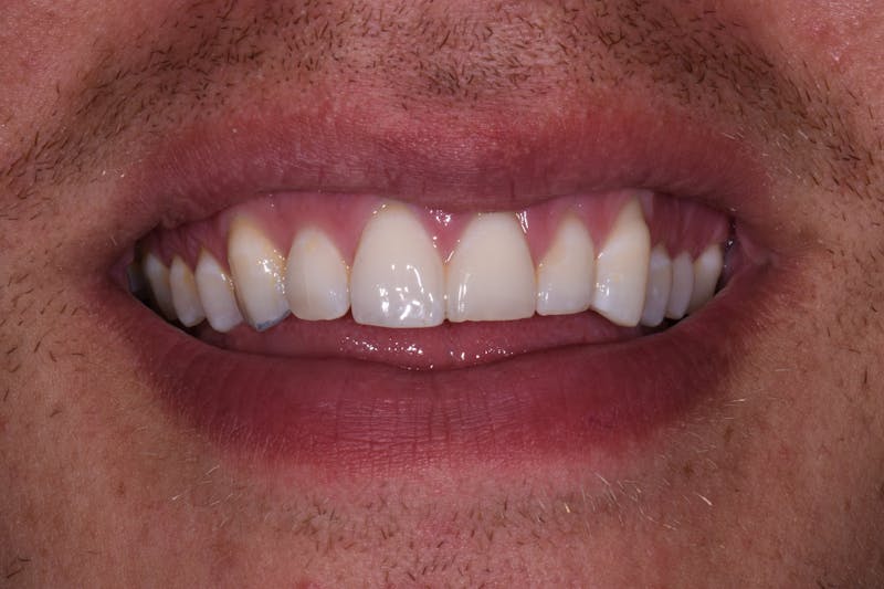 Patient Smile Before & After Gallery - Patient 319776 - Image 3