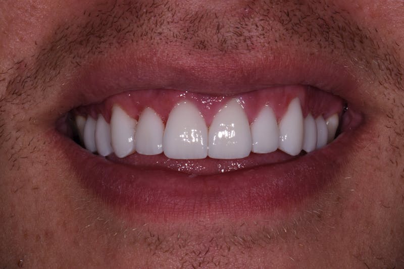 Patient Smile Before & After Gallery - Patient 319776 - Image 4