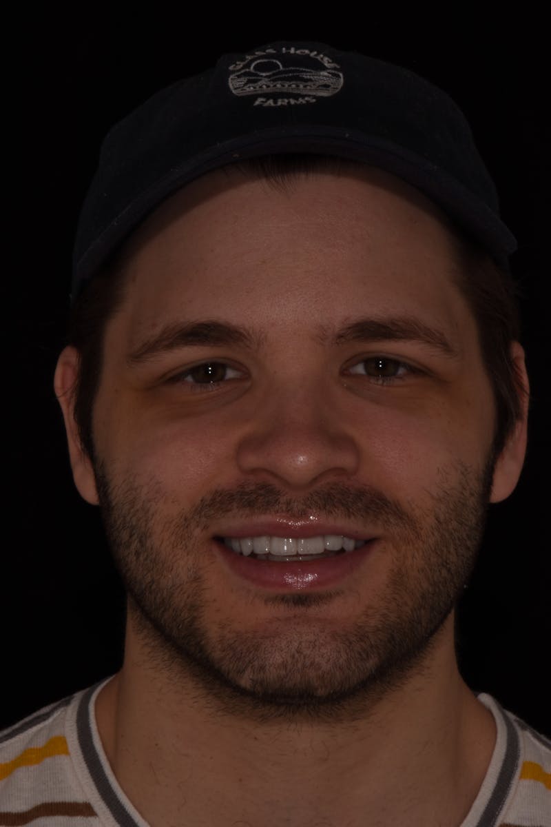 Patient Smile Before & After Gallery - Patient 525653 - Image 2