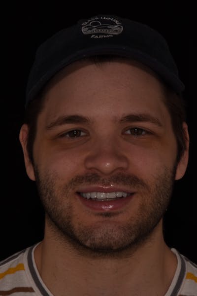 Patient Smile Before & After Gallery - Patient 525653 - Image 2