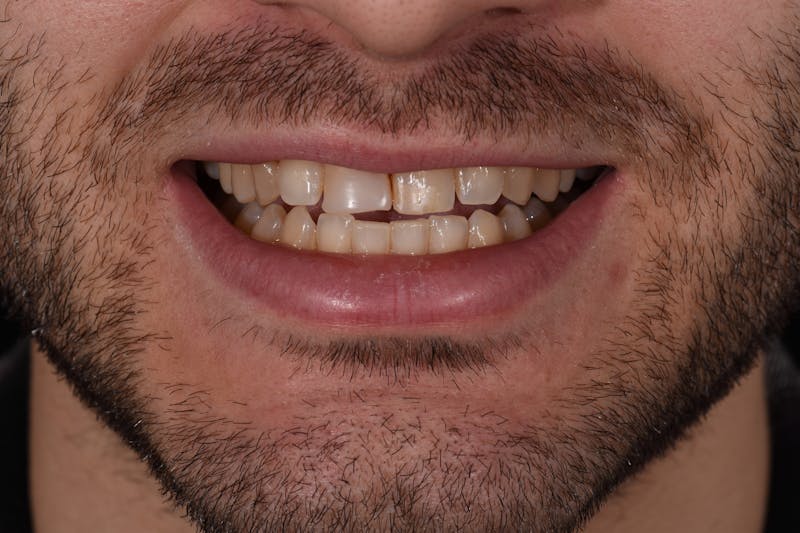 Patient Smile Before & After Gallery - Patient 525653 - Image 3