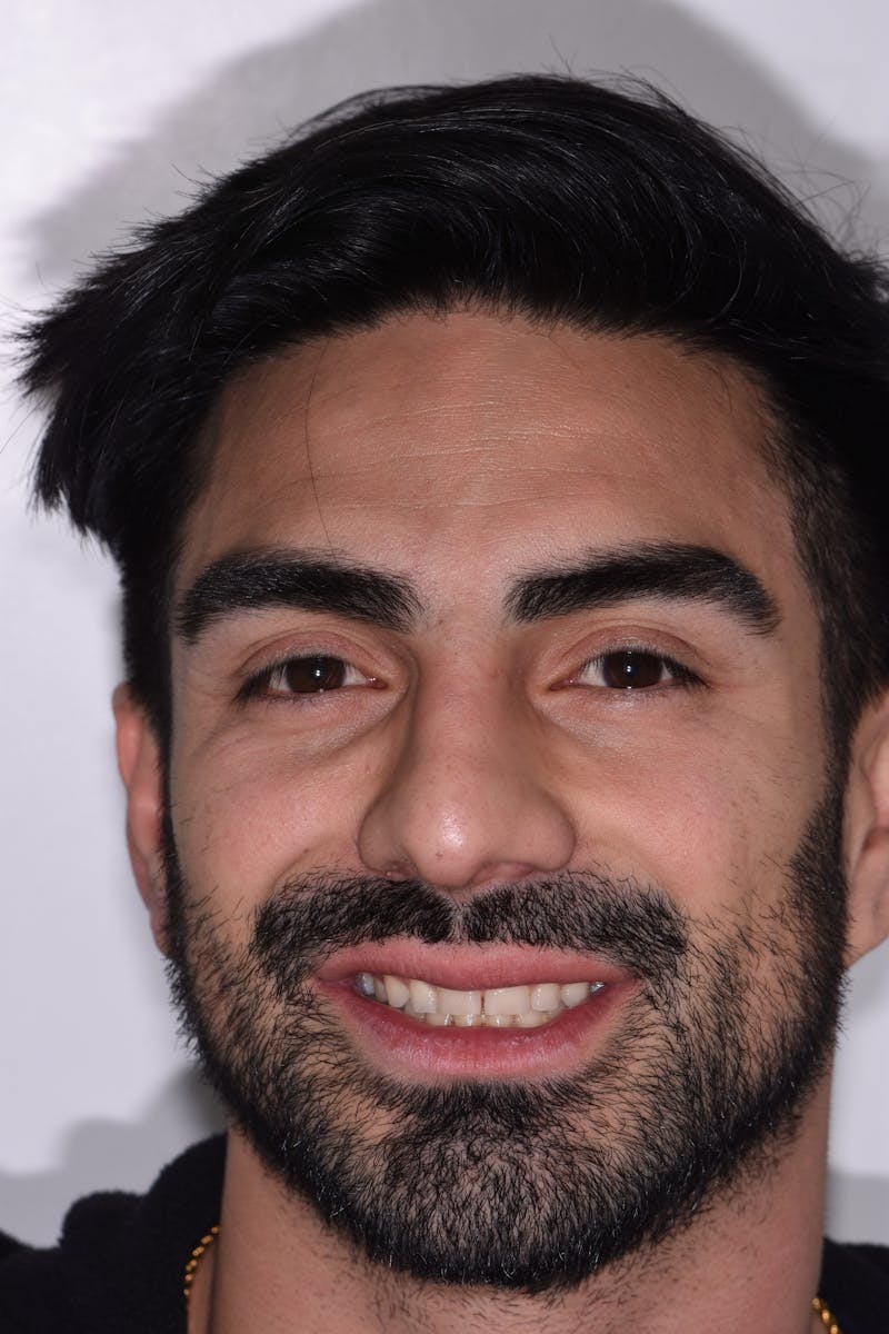 Patient Smile Before & After Gallery - Patient 385987 - Image 1