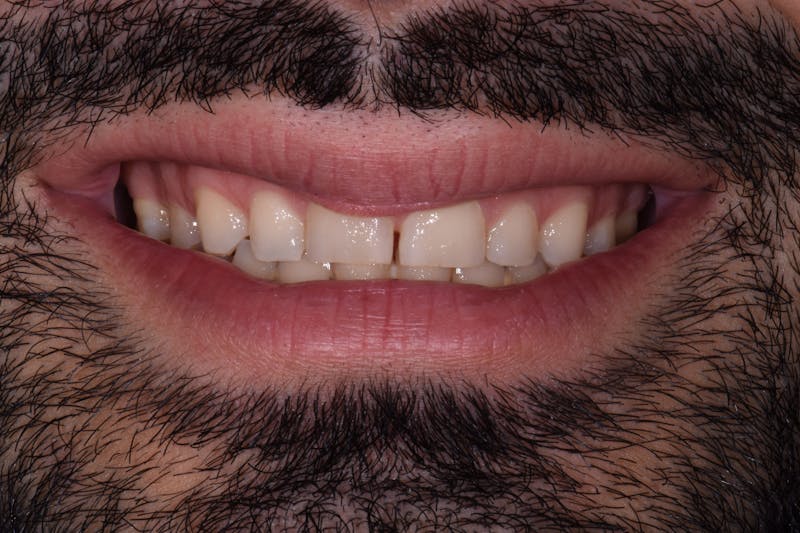 Patient Smile Before & After Gallery - Patient 385987 - Image 3