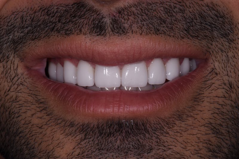 Patient Smile Before & After Gallery - Patient 385987 - Image 4