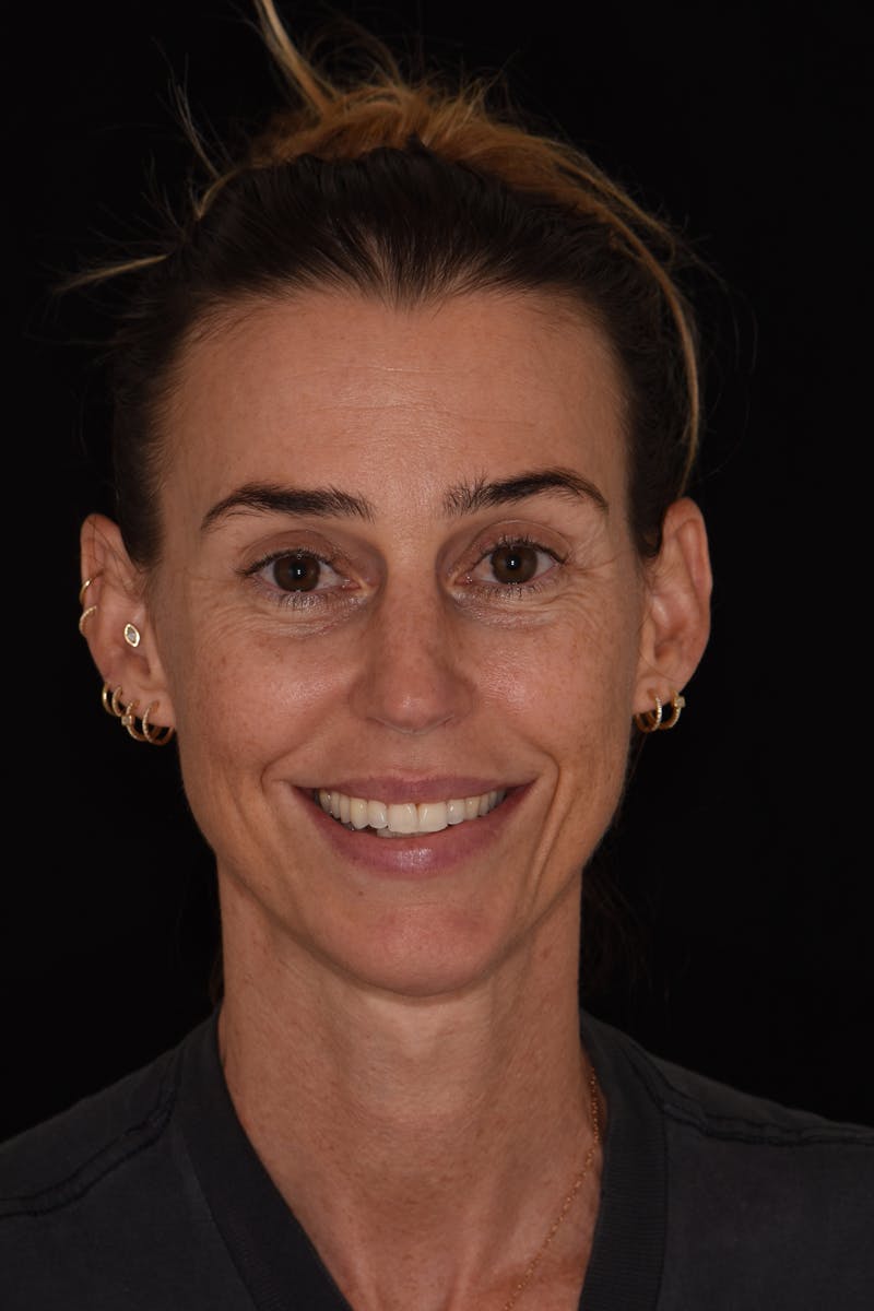 Patient Smile Before & After Gallery - Patient 403601 - Image 1