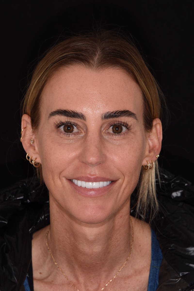 Patient Smile Before & After Gallery - Patient 403601 - Image 2