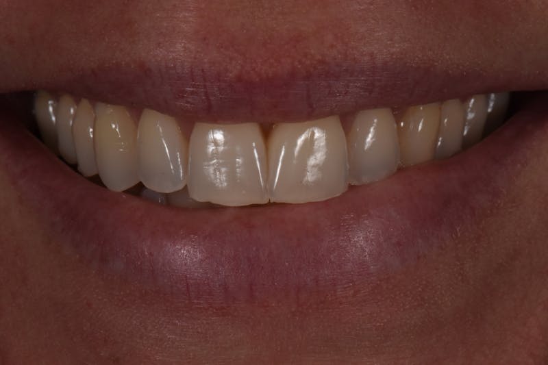 Patient Smile Before & After Gallery - Patient 403601 - Image 3