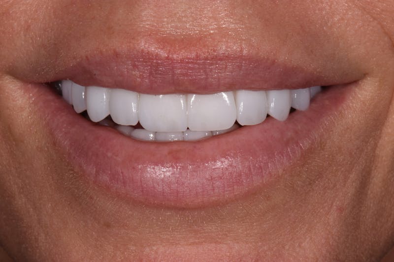 Patient Smile Before & After Gallery - Patient 403601 - Image 4