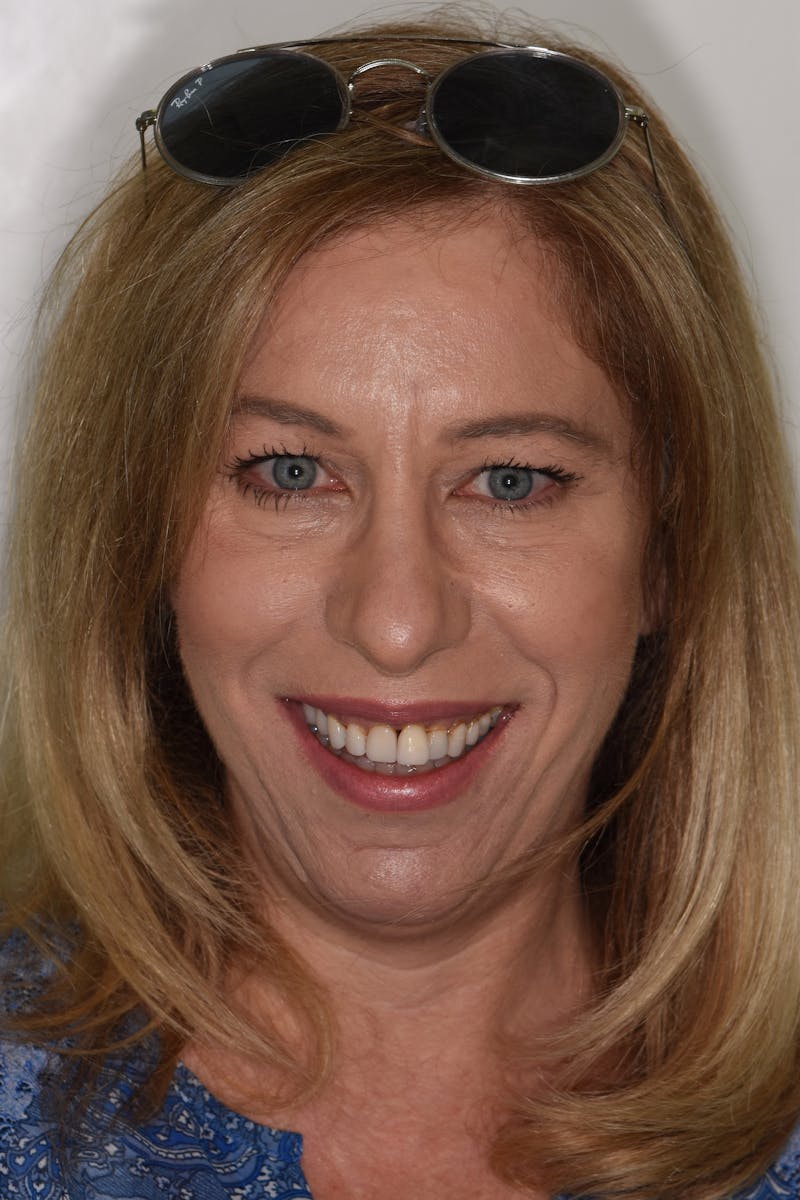 Patient Smile Before & After Gallery - Patient 204865 - Image 1