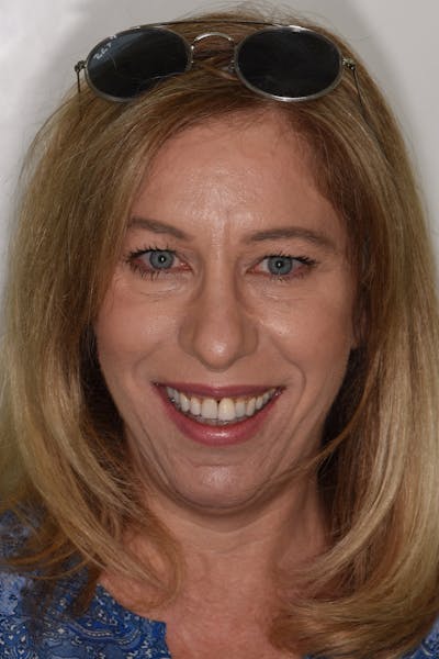 Patient Smile Before & After Gallery - Patient 204865 - Image 1