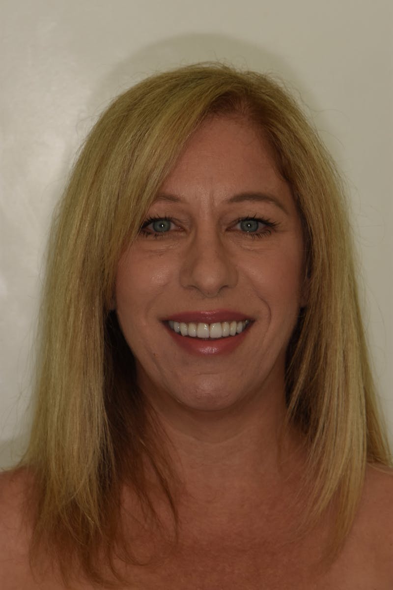 Patient Smile Before & After Gallery - Patient 204865 - Image 2