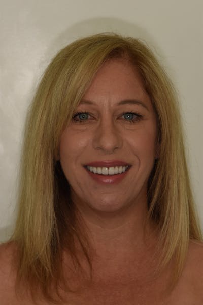 Patient Smile Before & After Gallery - Patient 204865 - Image 2