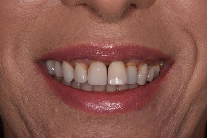 Patient Smile Before & After Gallery - Patient 204865 - Image 3