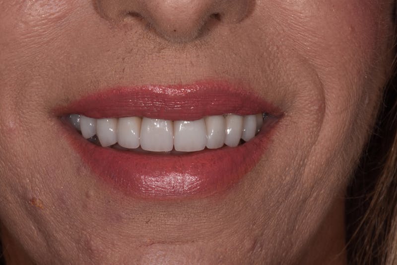 Patient Smile Before & After Gallery - Patient 204865 - Image 4