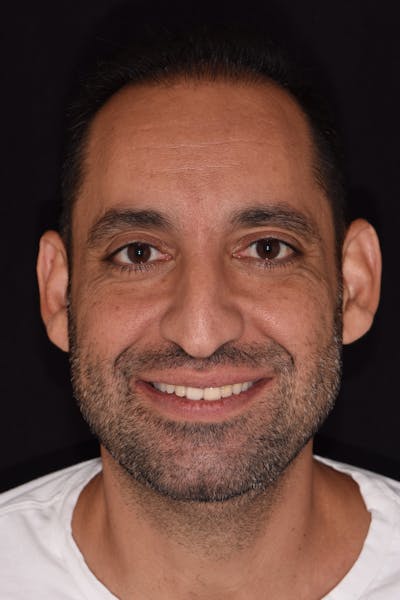 Patient Smile Before & After Gallery - Patient 278065 - Image 1