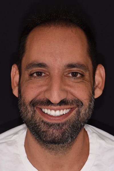 Patient Smile Before & After Gallery - Patient 278065 - Image 2