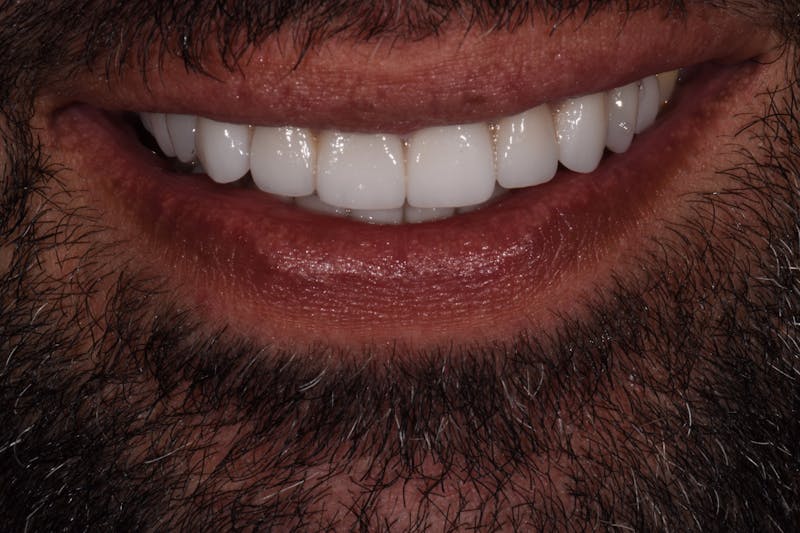 Patient Smile Before & After Gallery - Patient 278065 - Image 4