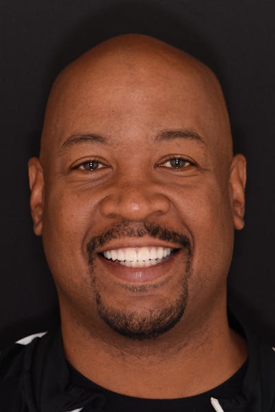 Patient Smile Before & After Gallery - Patient 841395 - Image 2