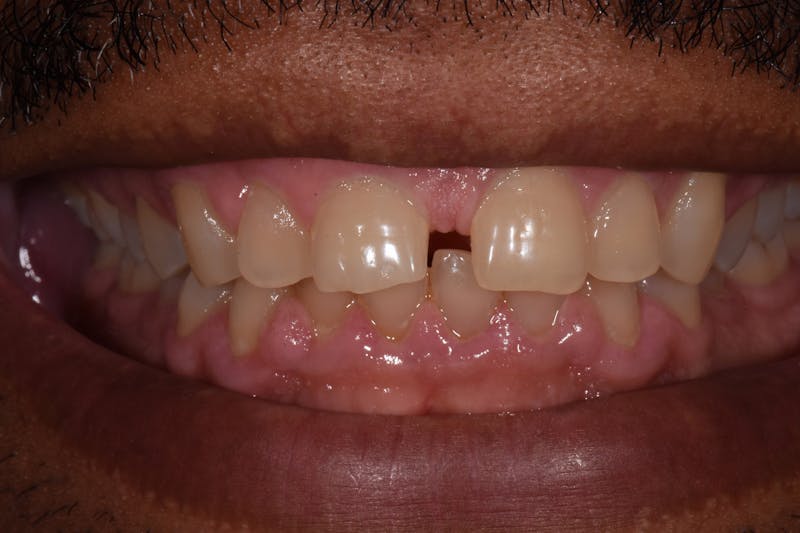 Patient Smile Before & After Gallery - Patient 841395 - Image 3