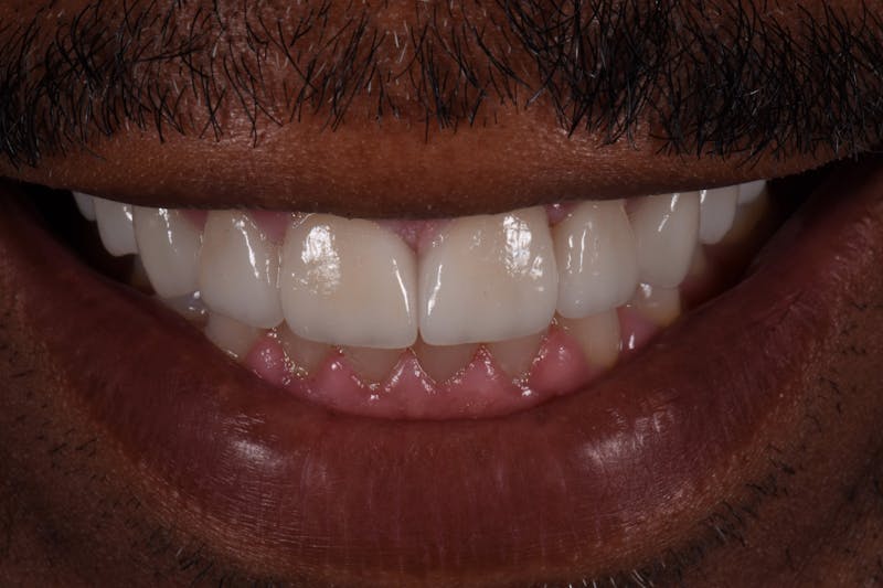 Patient Smile Before & After Gallery - Patient 841395 - Image 4