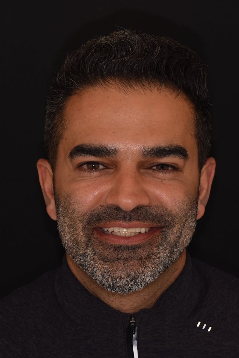 Patient Smile Before & After Gallery - Patient 353649 - Image 1