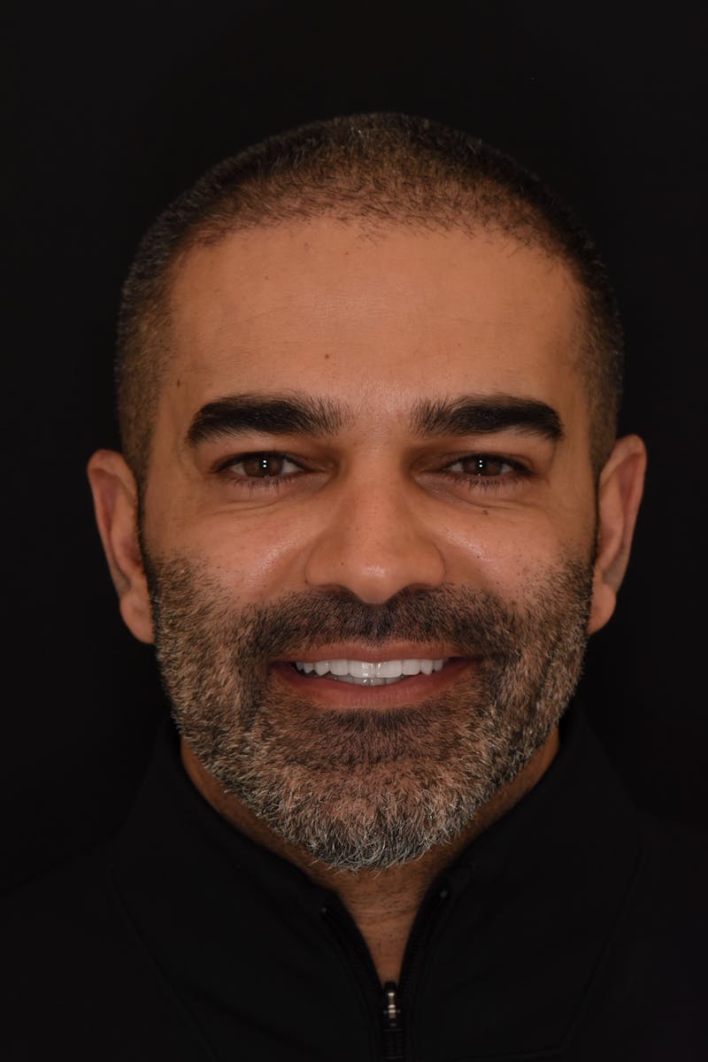 Patient Smile Before & After Gallery - Patient 353649 - Image 2