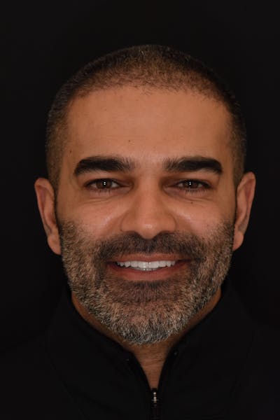 Patient Smile Before & After Gallery - Patient 353649 - Image 2