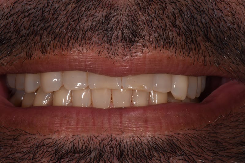 Patient Smile Before & After Gallery - Patient 353649 - Image 3