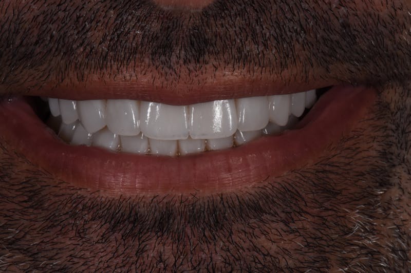 Patient Smile Before & After Gallery - Patient 353649 - Image 4