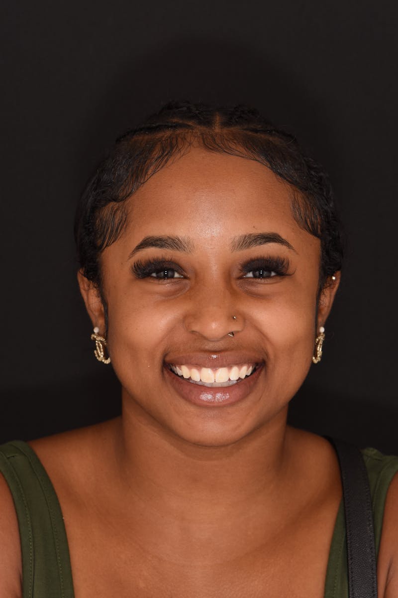 Patient Smile Before & After Gallery - Patient 624107 - Image 1