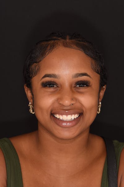 Patient Smile Before & After Gallery - Patient 624107 - Image 1