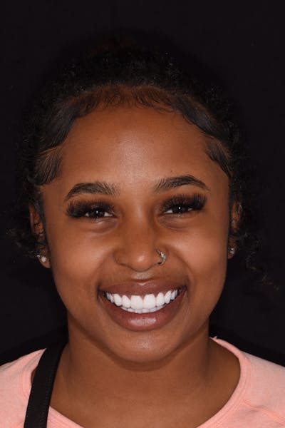 Patient Smile Before & After Gallery - Patient 624107 - Image 2