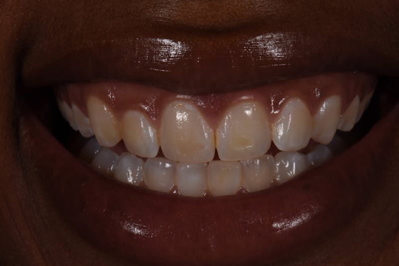 Patient Smile Before & After Gallery - Patient 624107 - Image 3