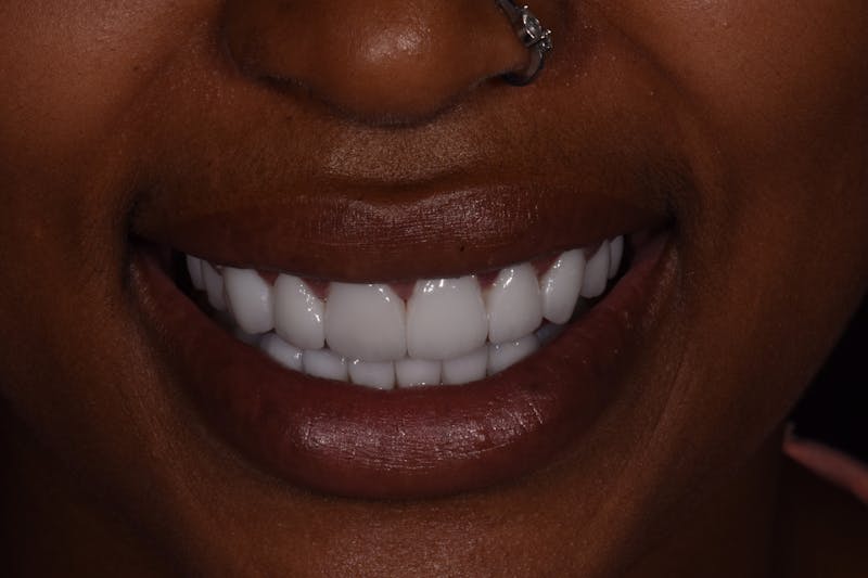 Patient Smile Before & After Gallery - Patient 624107 - Image 4